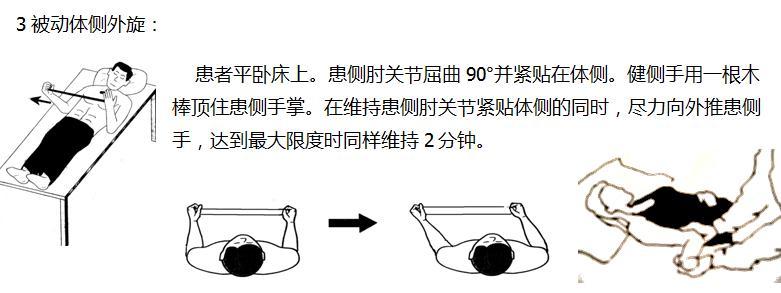 肩袖撕裂修补合并肩峰减压术后康复程序