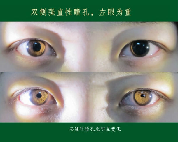 神经眼科瞳孔检查技术