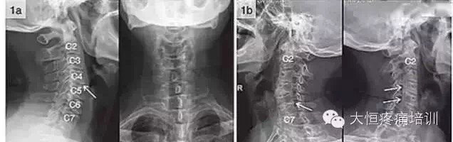 颈椎x线平片读片诊断口诀