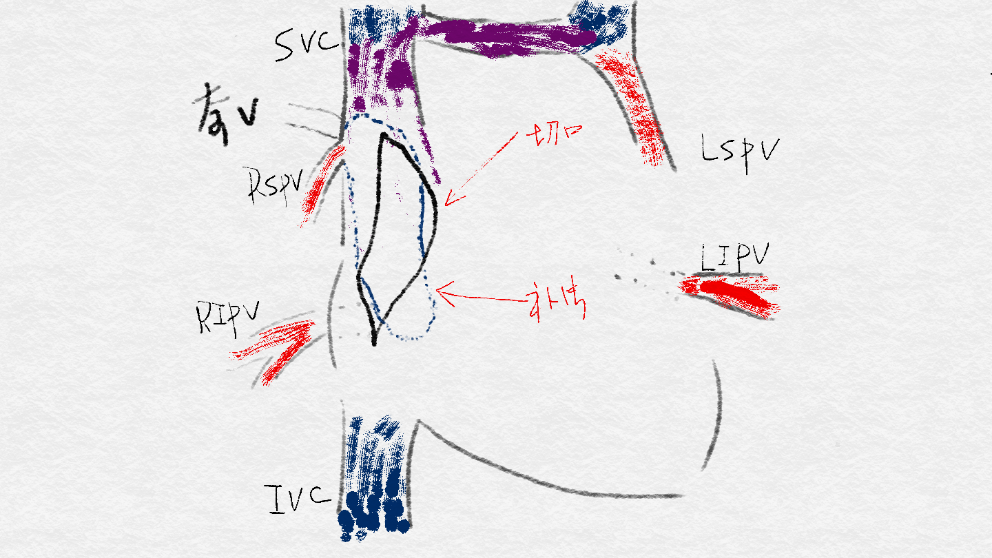 左上肺静脉异位引流右上肺静脉异位引流
