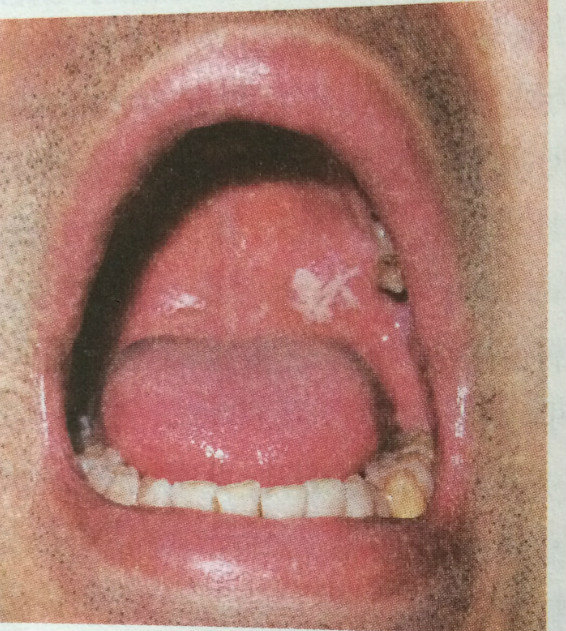 口腔真菌感染图片