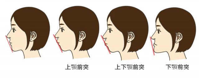 不拔牙矫正靠谱吗会不会对脸型改善不大