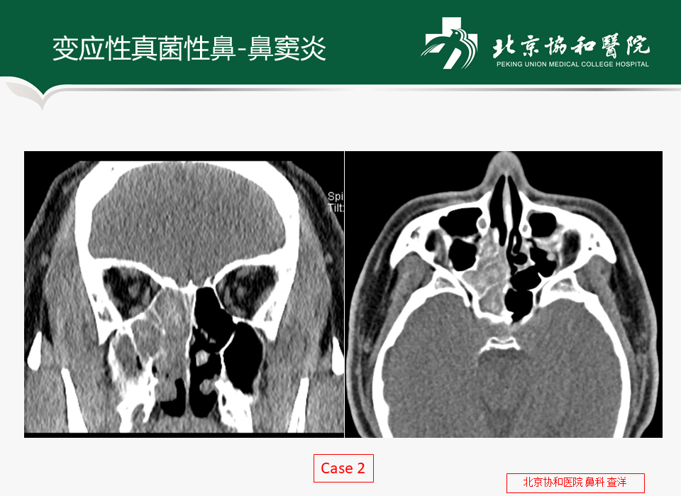 真菌性鼻窦炎患者手术常见问题及注意事项