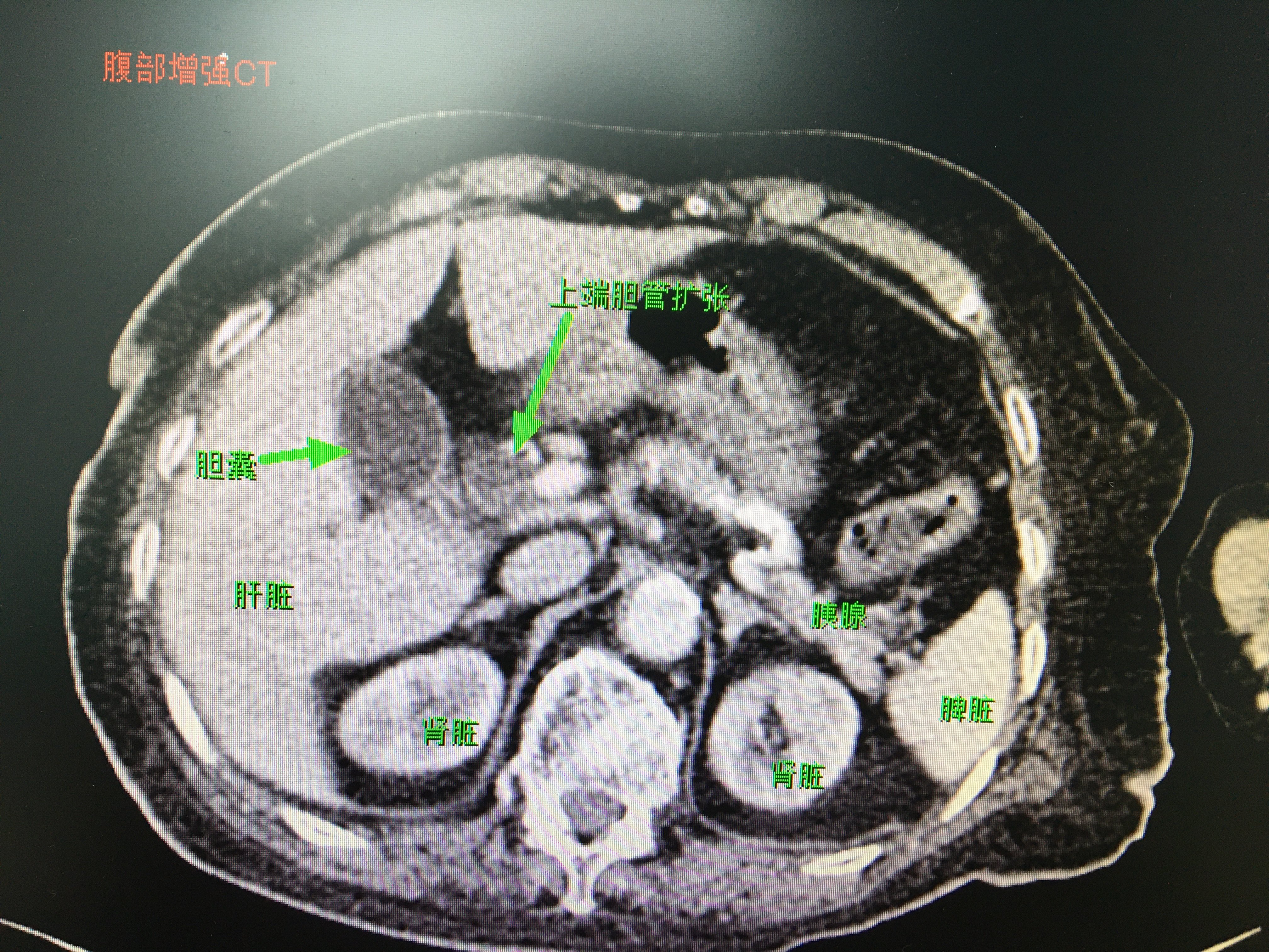 ct提示胆总管泥沙样结石可能,近端胆管及肝内胆管扩张.