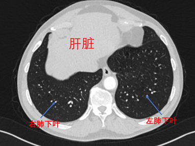 如何用手机拍摄高清肺结节ct照片