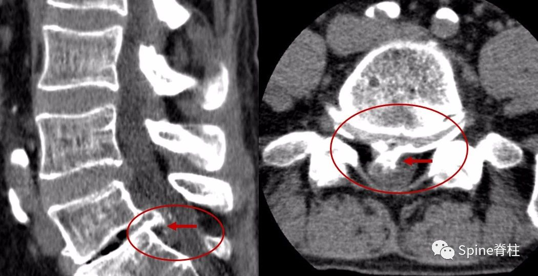 腰椎ct示l5-s1椎间盘突出伴骨化