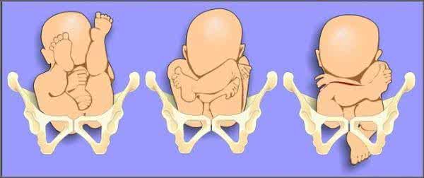 怀臀位宝宝的危险因素及分娩方式选择