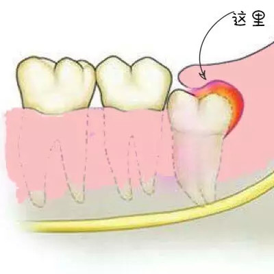 1,反复发作的冠周炎:阻生的智齿牙冠周围软组织与牙齿之间形成一盲袋