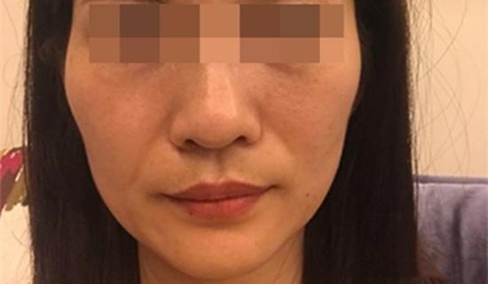 随着鼻唇沟的加深,鼻唇褶皱的扩大和颌下脂肪的出现,软组织的变化造成