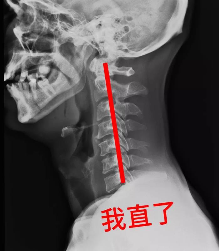 低头玩手机,颈椎病悄然而来!