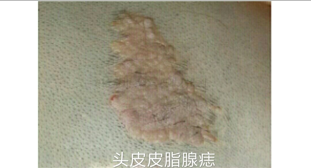 皮脂腺痣简述