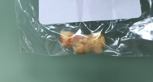 突破上限航空总医院脑血管病神经外科完成超高龄90岁