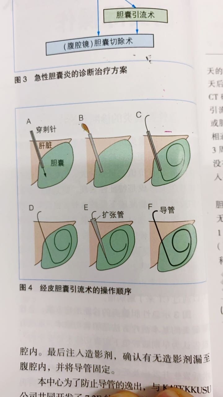 ptbdg经皮胆囊穿刺引流