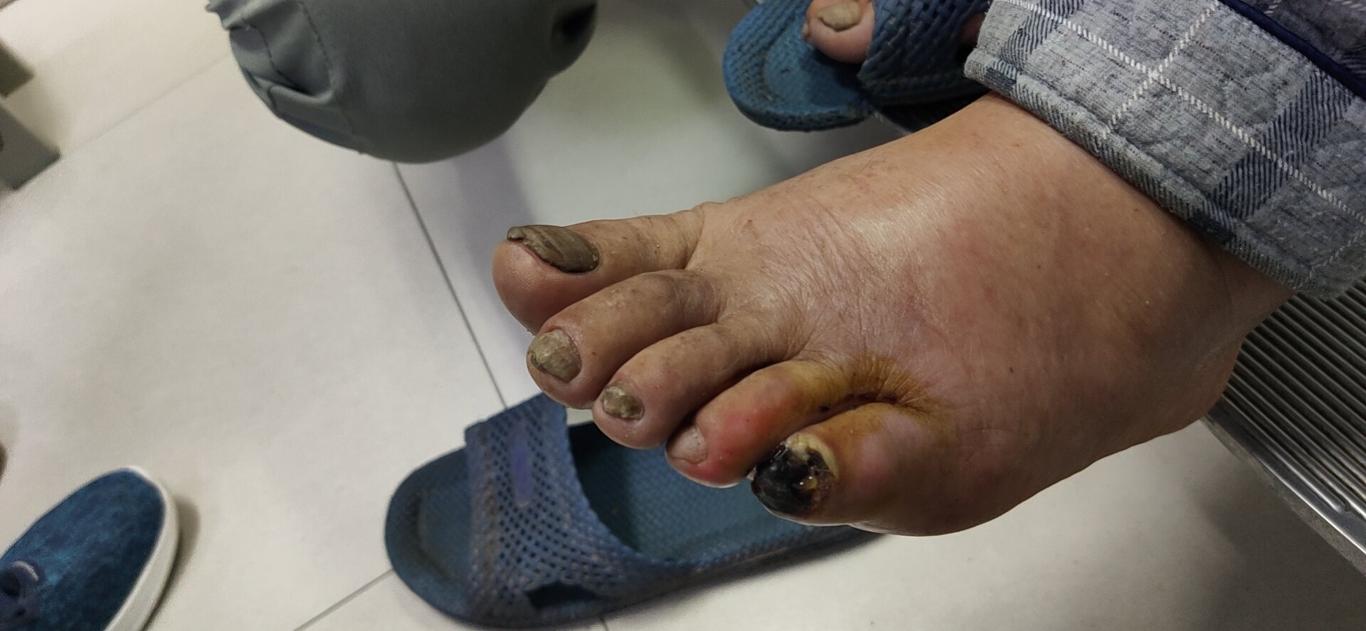 手术前后糖尿病足该注意哪些