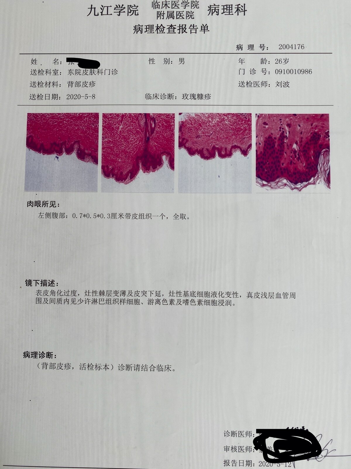 色素性玫瑰疹