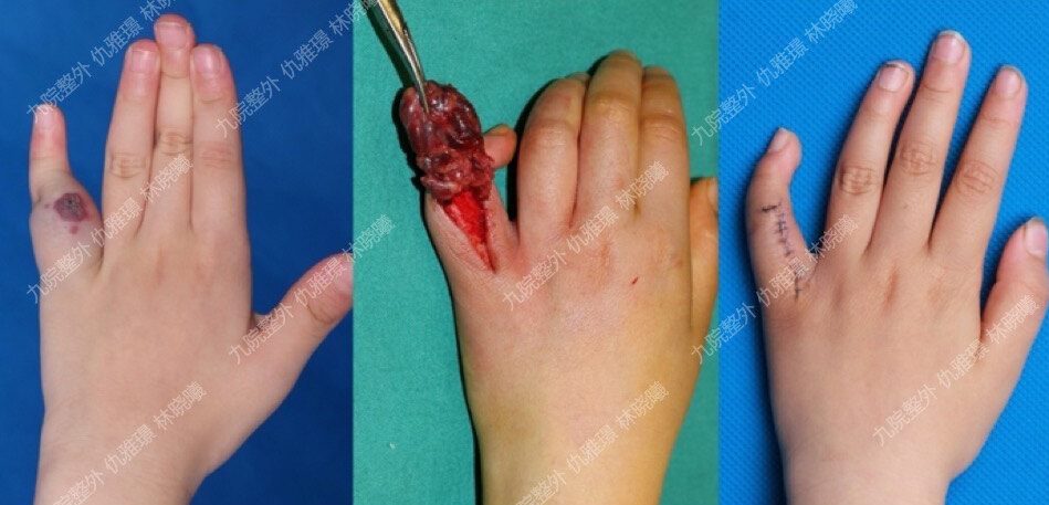 手指局限性疣状静脉畸形切除术前,术中,术后