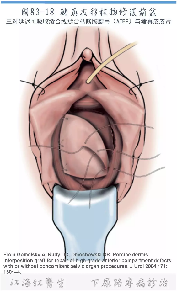 下尿路整合盆底 12 | 盆腔器官脱垂经阴和经腹重建手术介绍系列