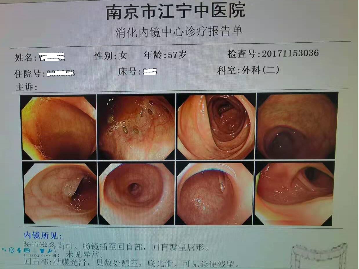 间歇性右下腹疼痛6年结肠憩室炎