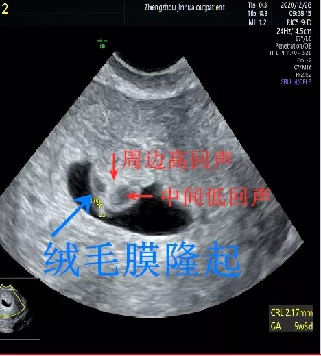 神秘的绒毛膜隆起:虽凶险,仍可医