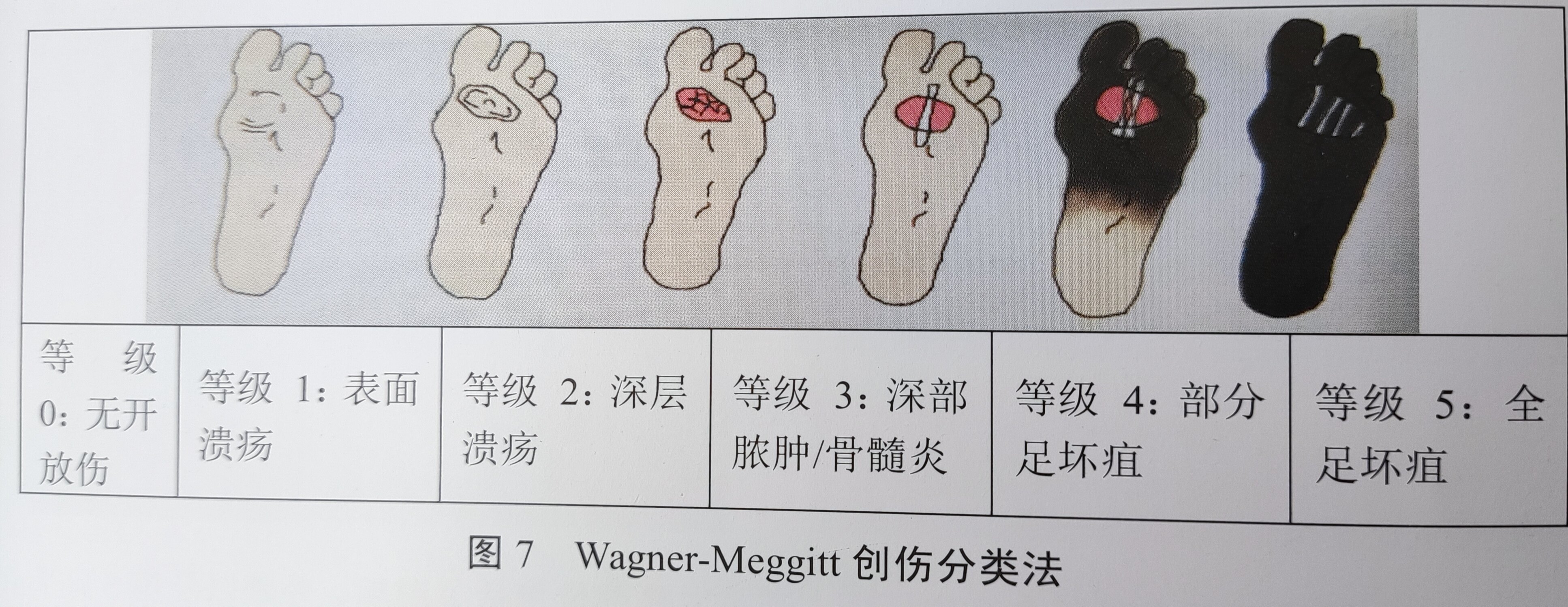 糖尿病足wagner-meggitt创伤分类法