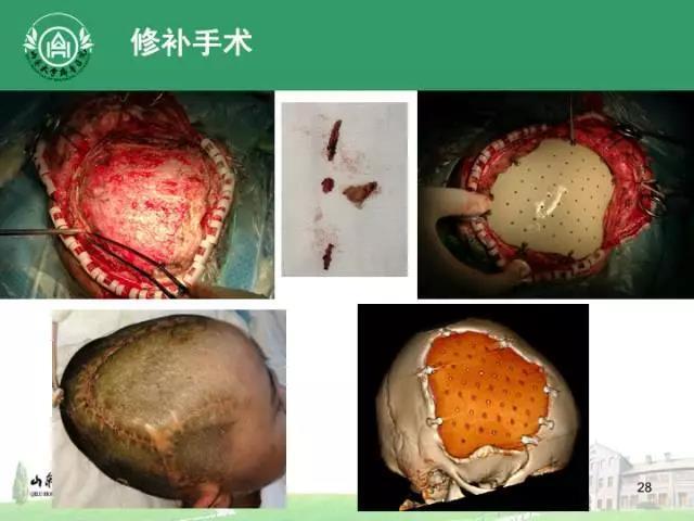 颅骨缺损修补peek
