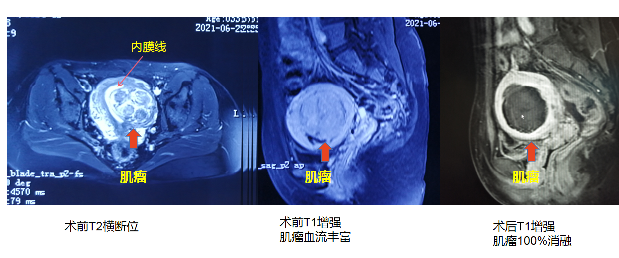 黏膜下子宫肌瘤海扶刀治疗病例分享