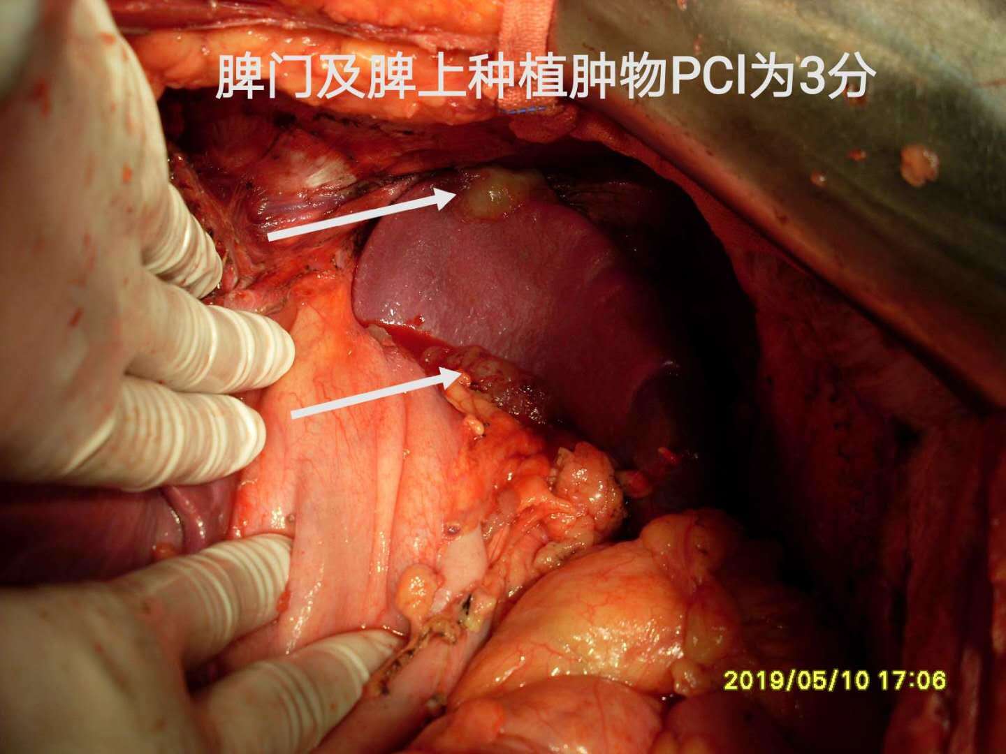 病例59--阑尾源性高级别pmp累及宫颈,卵巢之治疗