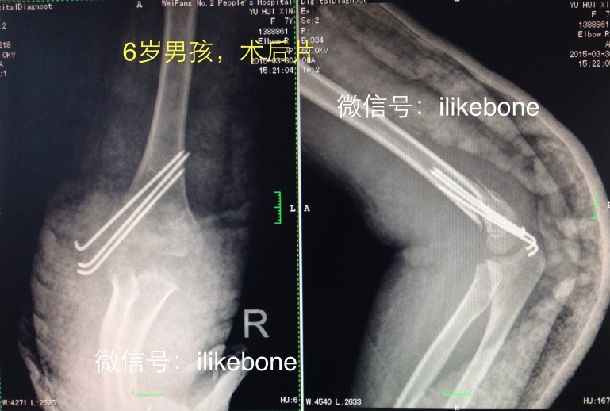 儿童肱骨髁上骨折父母需要知道的事情