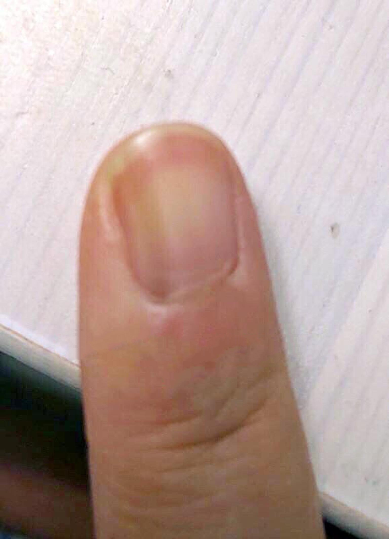 关于皮肤鳞癌,恶性黑色素瘤,皮肤痣,指甲痣的区别您知道吗?
