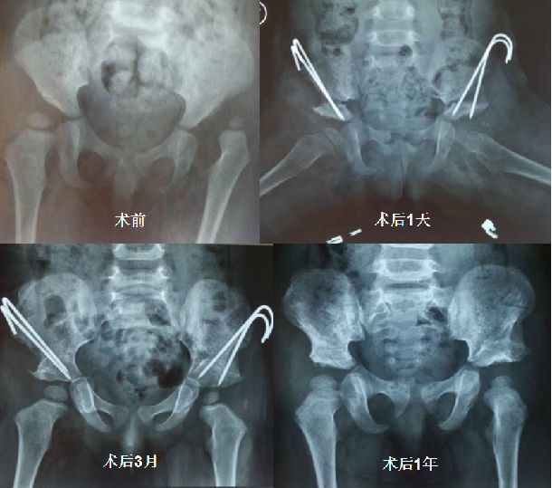 髋关节脱位系列1:一期手术治疗双侧脱位及随访效果