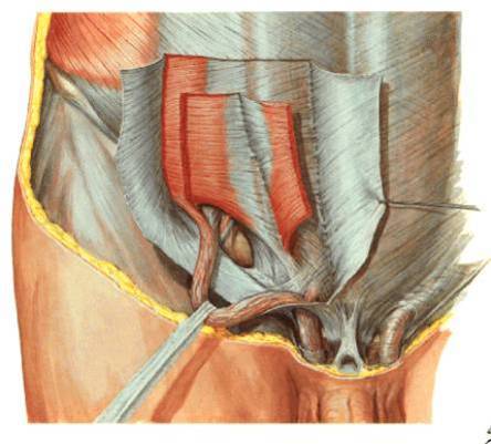 肿块多呈半圆形,从hesselbachˊs三角区向前突出 不进入腹股沟管内环
