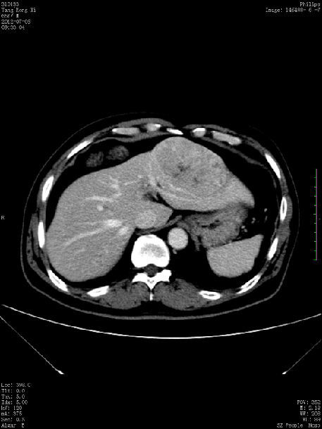 术前ct片,左肝肿瘤考虑原发性肝癌.