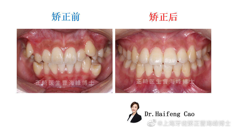 【牙齿拥挤有虎牙】矫正案例