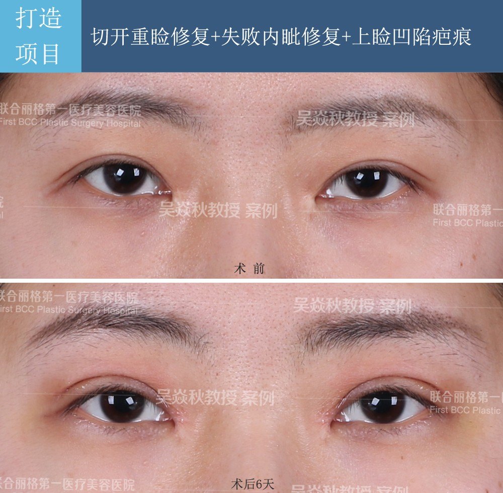 吴焱秋教授:双眼皮手术失败案例分析—失败原因及修复