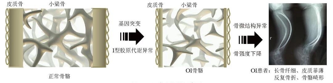 骨骼外表现可以有蓝巩膜,牙本质发育不全,听力下降,韧带松弛,心脏瓣膜