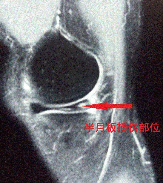 膝关节半月板损伤的关节镜微创手术