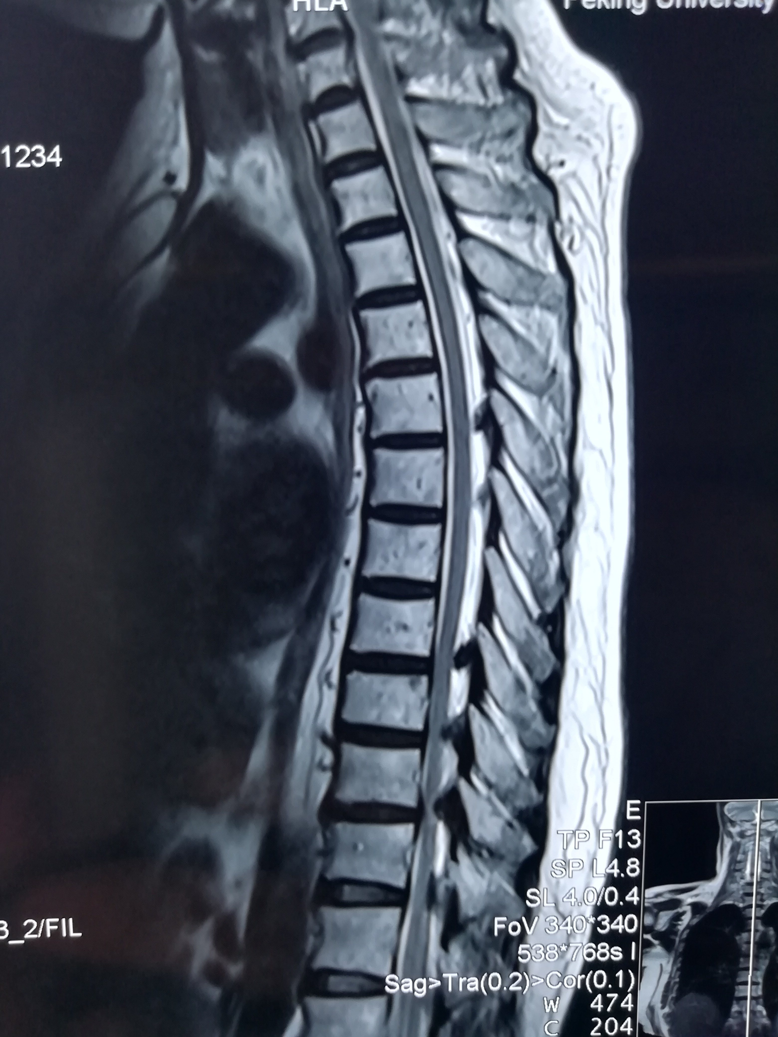 一个50多岁的女性,下肢打软麻木走路发飘不稳三个月,胸椎核磁看到脊髓