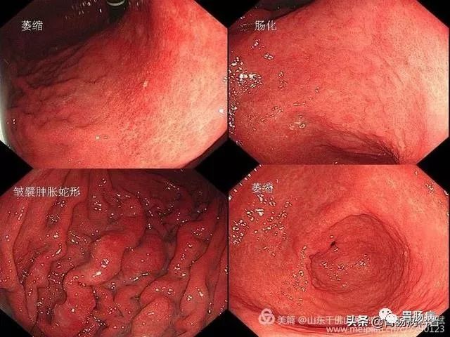 胃炎与胃癌的前世今生!