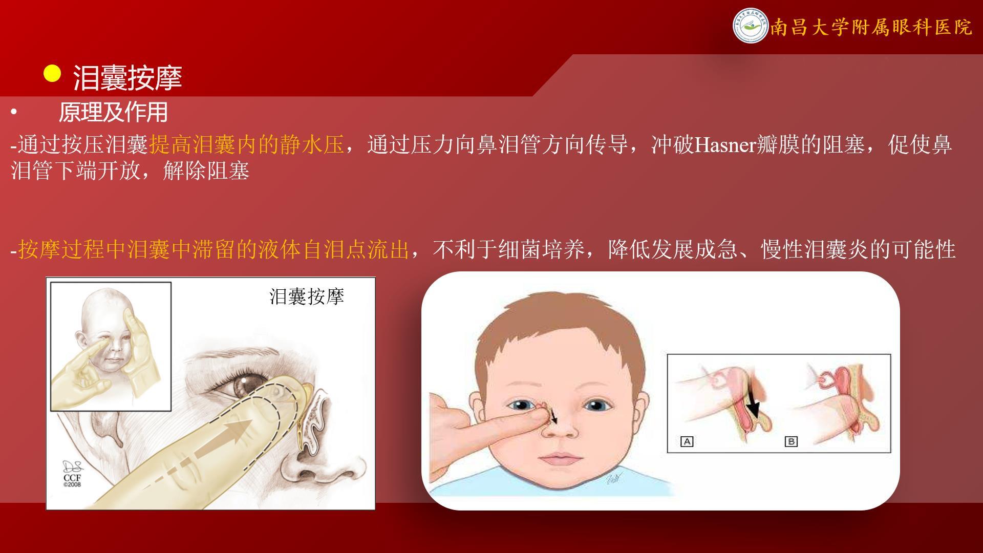 67关于"先天性鼻泪管阻塞,新生儿泪囊炎,泪囊按摩"的相关问题
