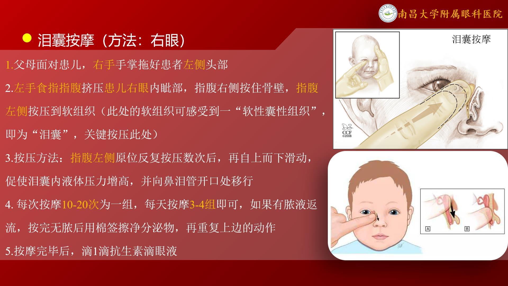 8203关于先天性鼻泪管阻塞新生儿泪囊炎泪囊按摩的相关问题