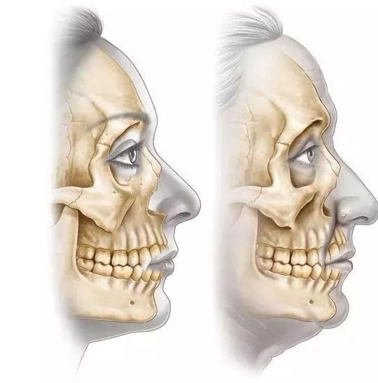凹陷的人通常是因为梨状孔周围的上颌骨发育不良,医学上称为骨性凹陷