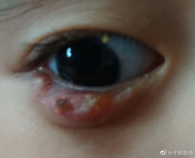 儿童反复霰粒肿手术长大以后会干眼