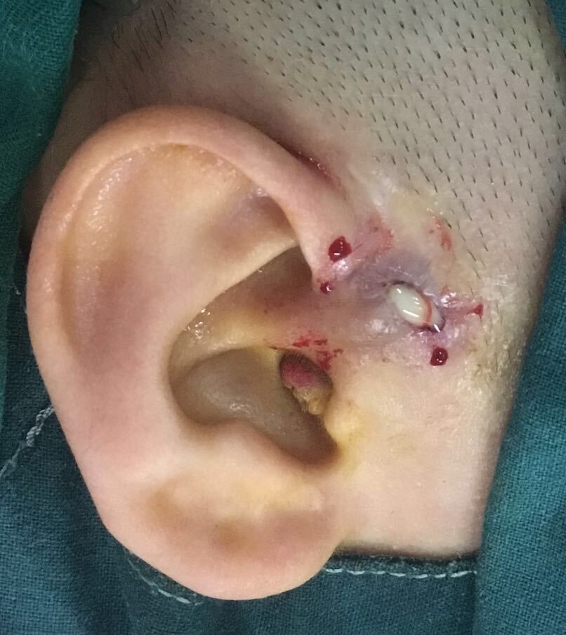耳前瘘管感染期可以手术吗_先天性耳前瘘管 好大夫在线