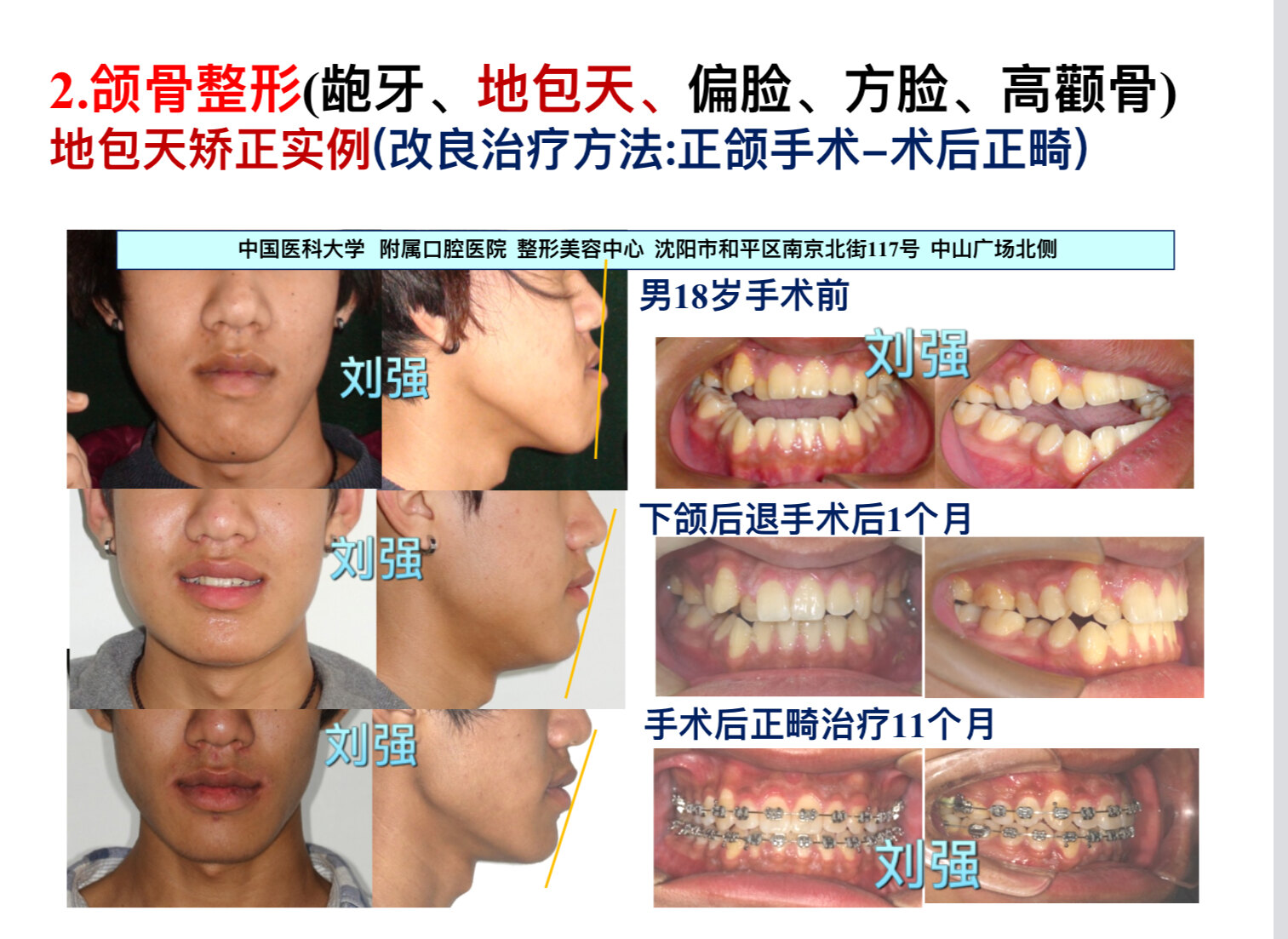 好大夫在线 刘强 > "地包天"整形案例分享3     手术前先在牙齿模型上