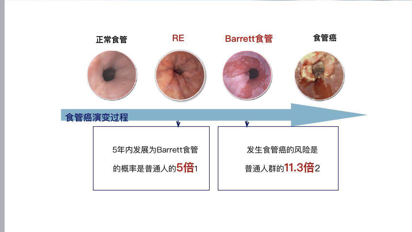 胃食管返流病对于食道两大功能的损害