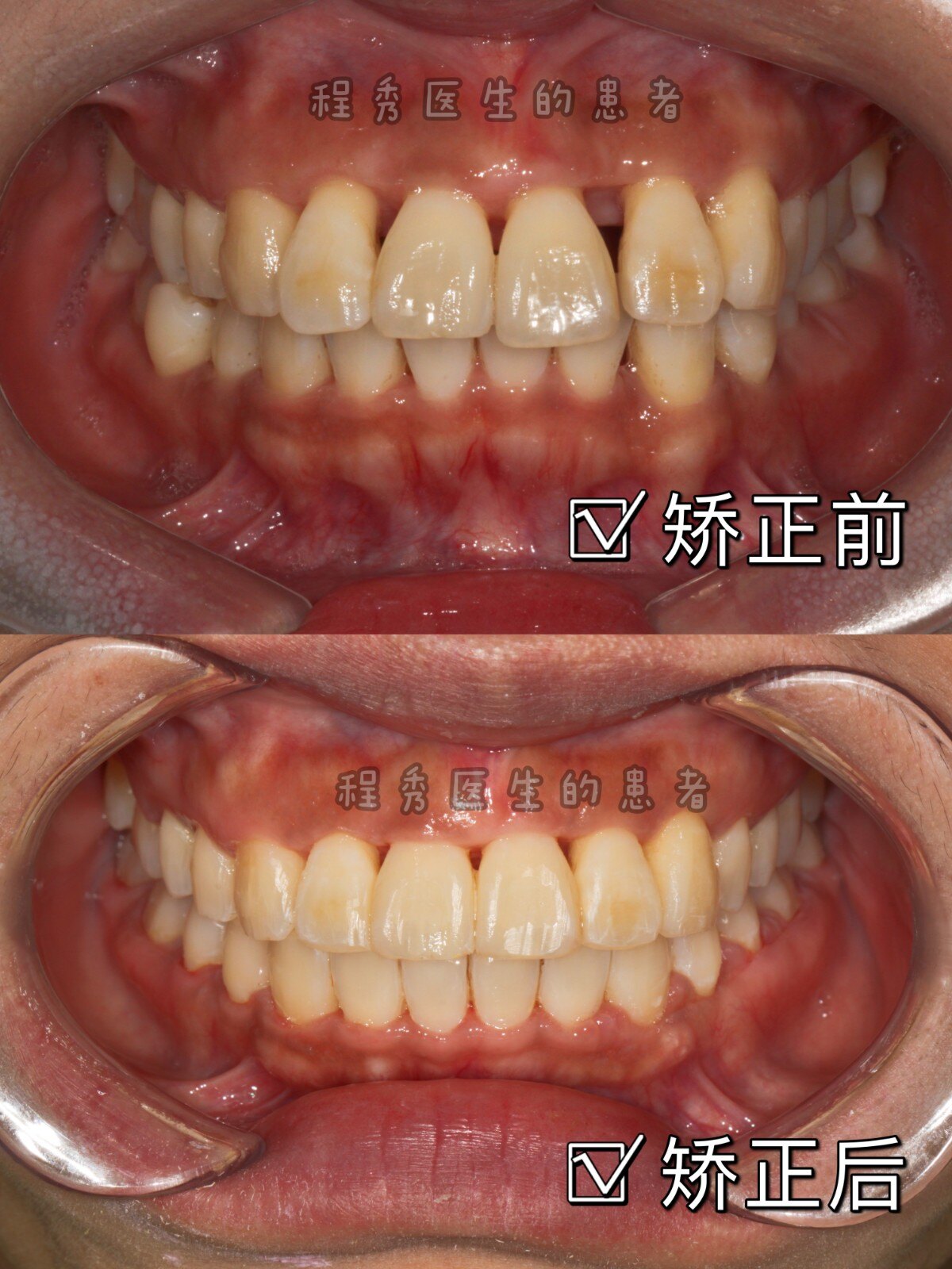 有牙周病可以矫正牙齿吗?