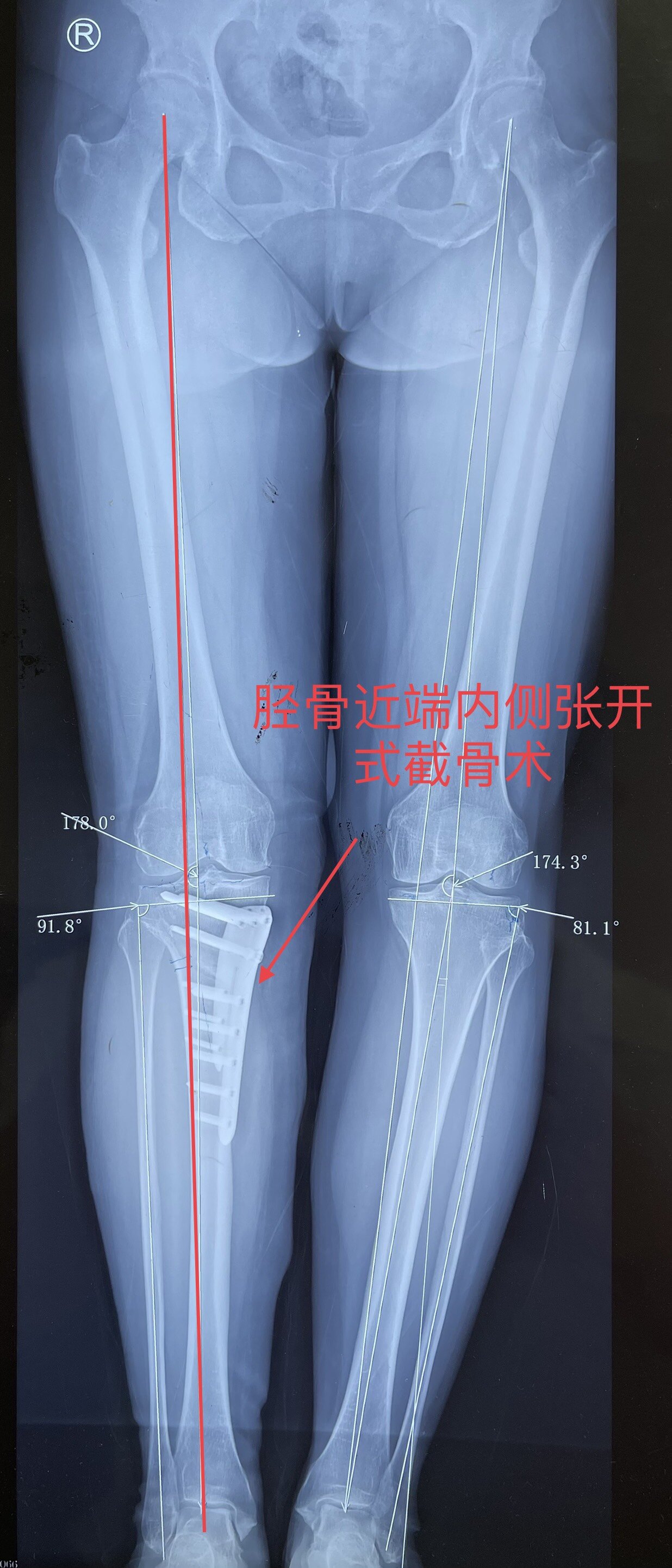 保膝治疗(截骨术),右膝胫骨近端内侧张开式截骨术后,改善下肢力线
