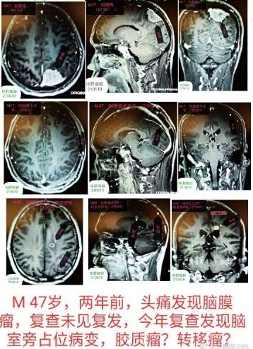 过度体检脑膜瘤术后两年发现同侧胶质瘤病案一例