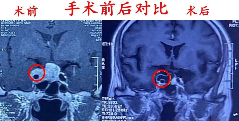 内镜下微创全切高难度侵袭性垂体瘤一例