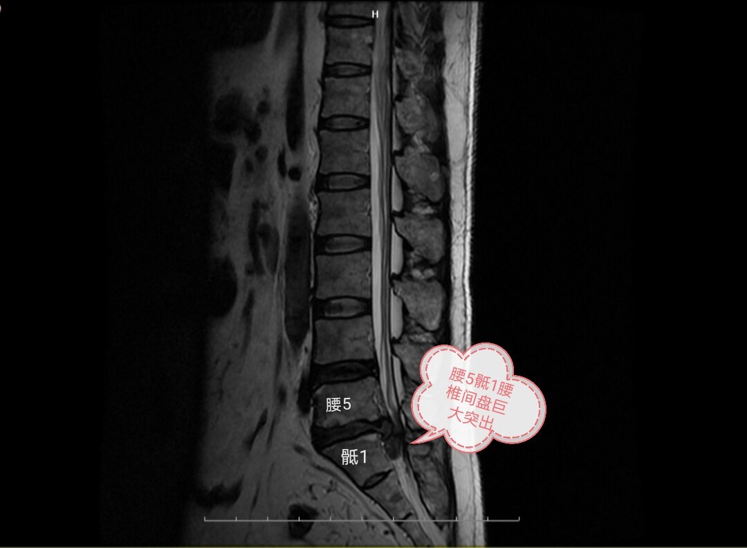 入院时腰椎核磁,t2矢状位,可见明显的腰5骶1腰椎间盘巨大突出.